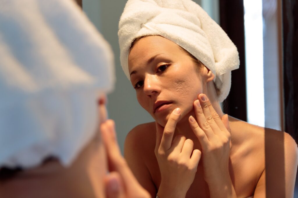 Acne Scare Treatment_final-min - Welcome to DMSI - Professional Surgical Dermatology Services | Dermatology