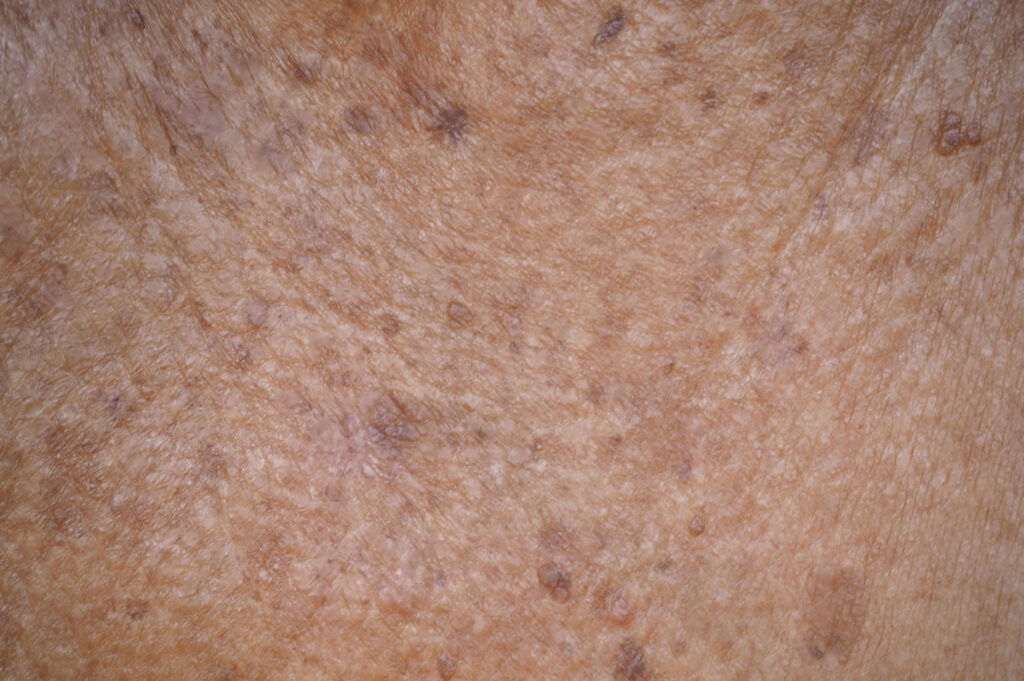 actinic keratosis or melanoma and seborrheic keratosis on collar - Welcome to DMSI - Professional Surgical Dermatology Services | Dermatology