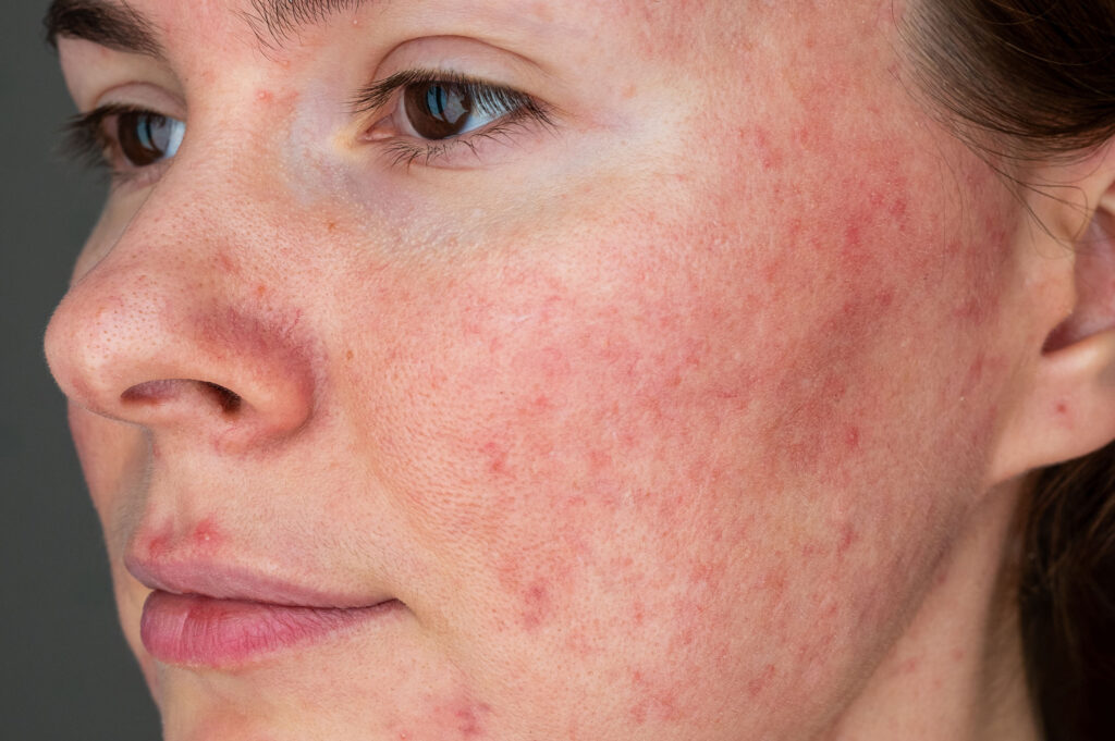 papulopustular rosacea face close up - Welcome to DMSI - Professional Surgical Dermatology Services | Dermatology