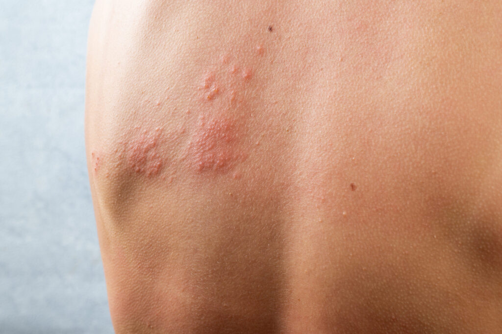 chickenpox rash Shingles varicella-zoster virus skin rash and blisters on body Skin infected Herpes zoster virus Herpes Virus on body urticaria rash atopic dermatitis - Welcome to DMSI - Professional Surgical Dermatology Services | Dermatology