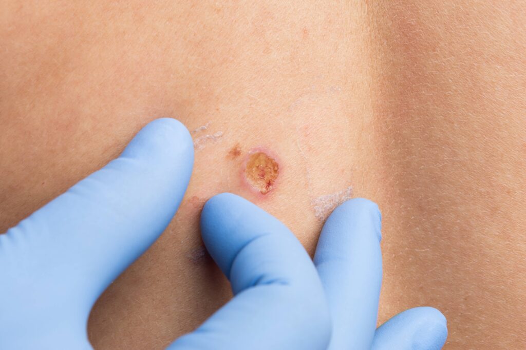 Electrodessication and Curettage_final-min - Welcome to DMSI - Professional Surgical Dermatology Services | Dermatology